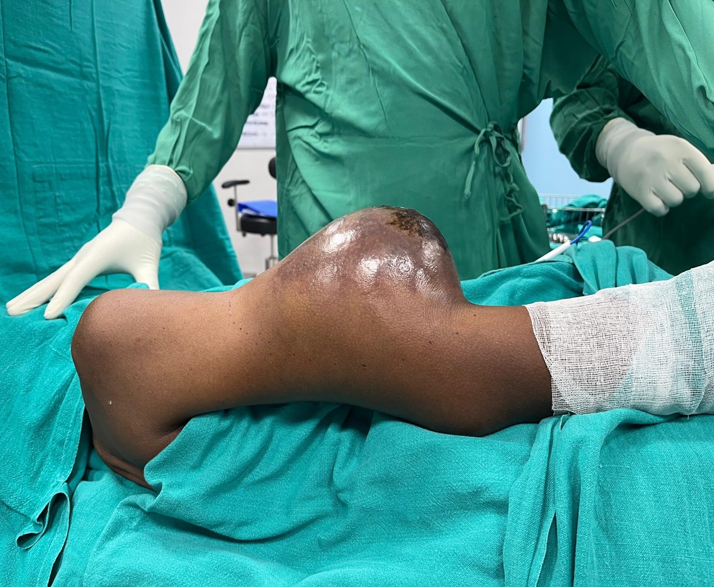 Soft Tissue Sarcoma Treatment