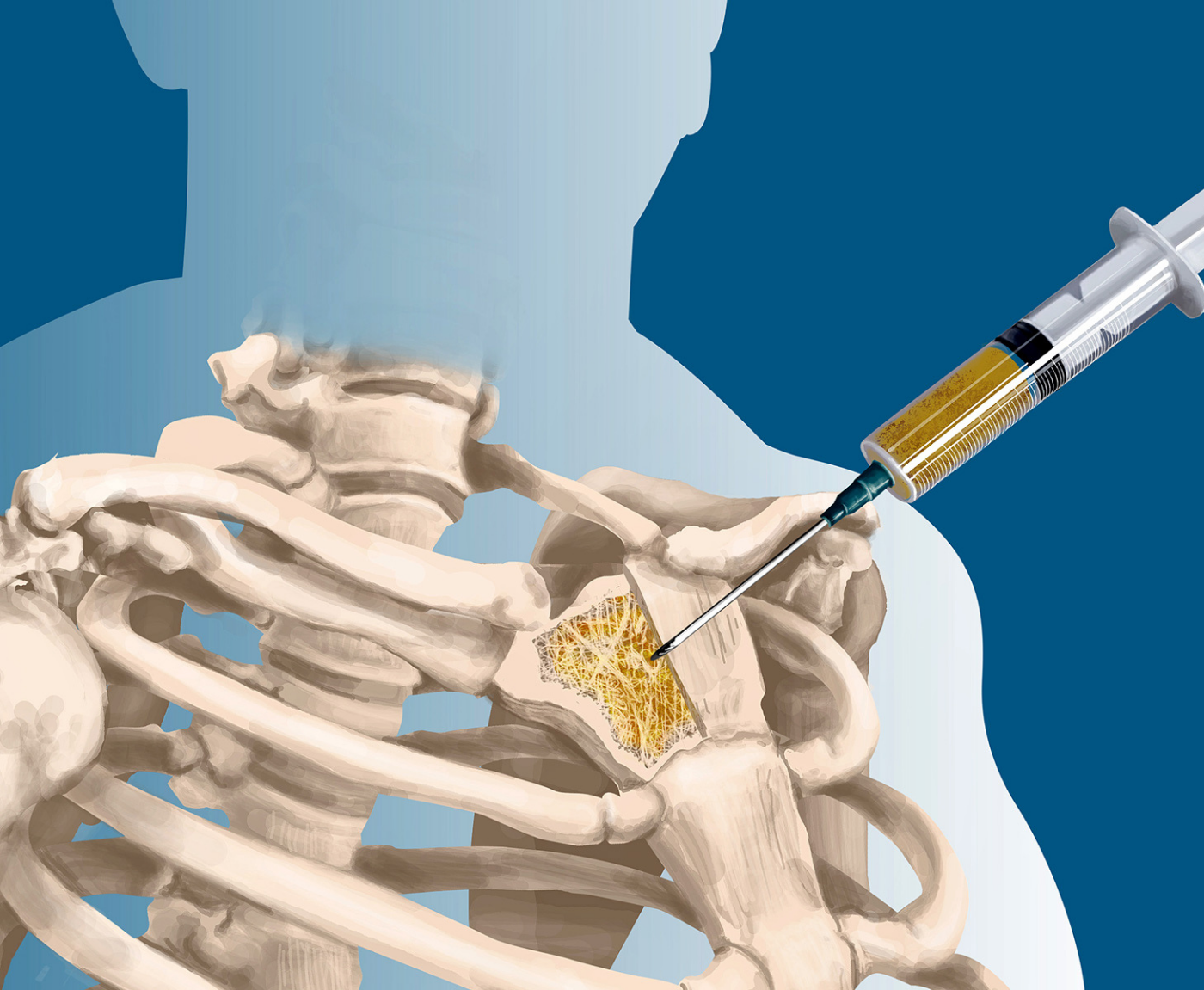 Bone and Soft Tissue Tumor Biopsy