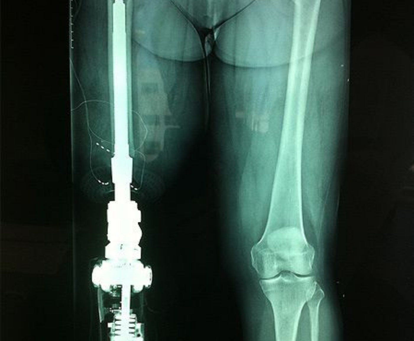 Expandable Megaprosthesis for Growing Children